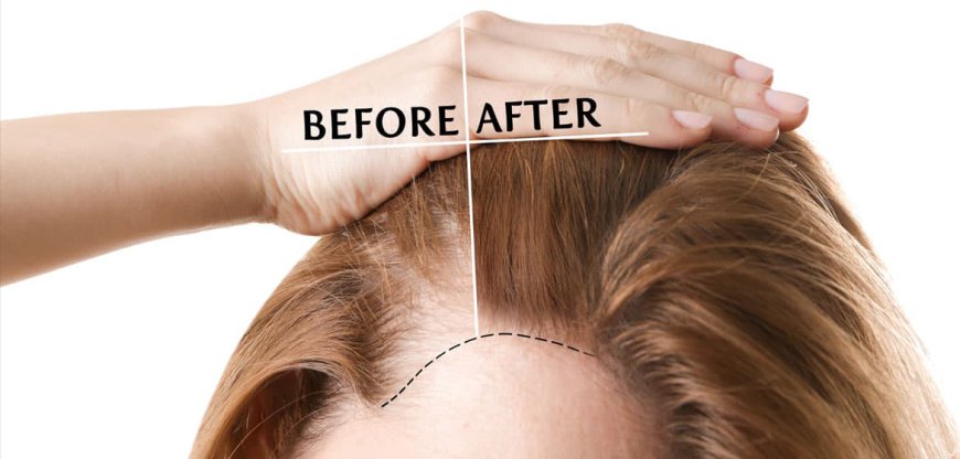 A Comprehensive Guide to Women’s Hair Transplant in Bangalore