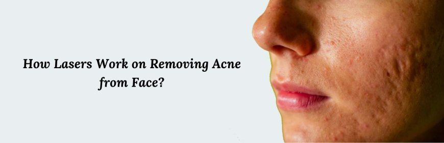 How Lasers Work on Removing Acne from Face?