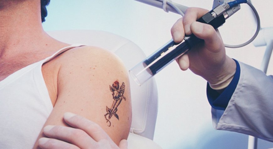 The Science Behind Picosure Laser Tattoo Removal Explained