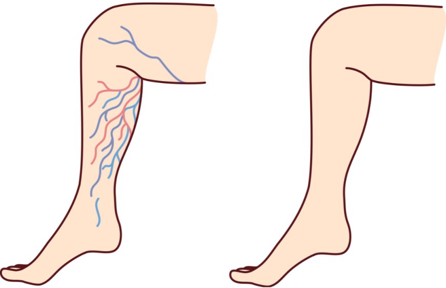 Effective Varicose Veins Treatment with Flowcare