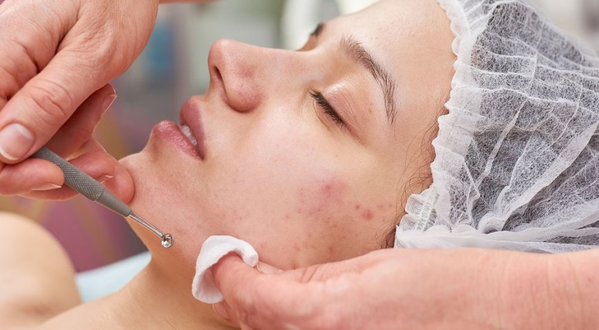 Can Acne Be Completely Treated? Discover the Most Effective Solutions