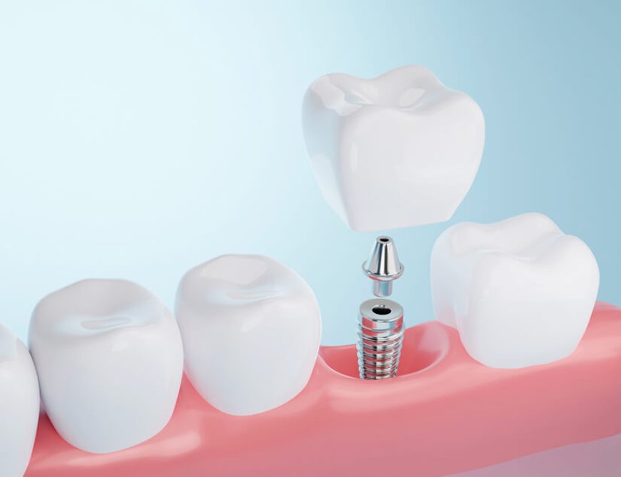 How Do I Prepare for a Single Tooth Implant Procedure in Dubai?