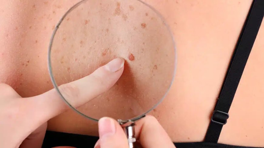 What Are the Alternatives to Skin Tag Removal?