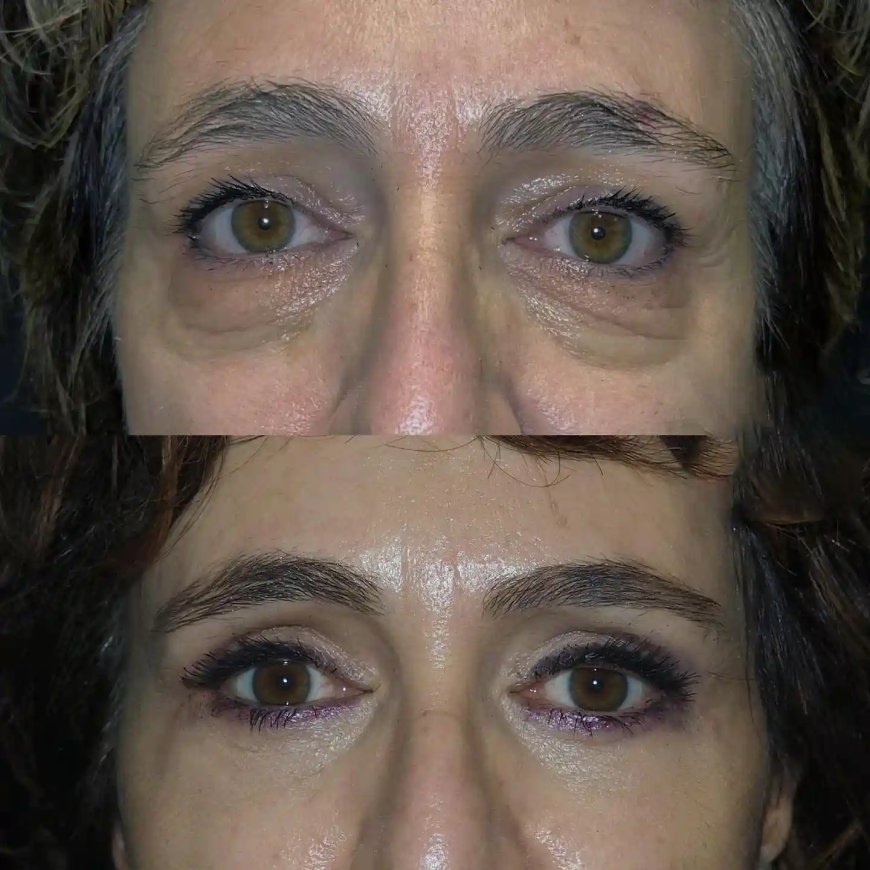 Why Eye bag removal in Dubai is Worth the Investment