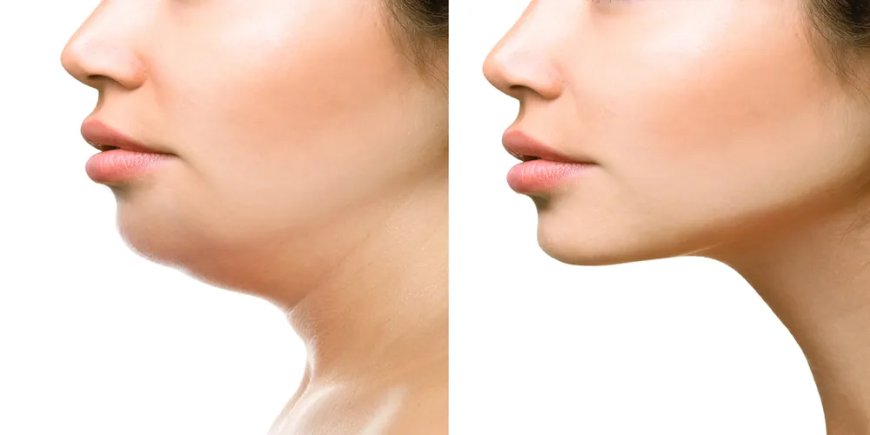 Double Chin Liposuction: Exploring Minimal-Invasive Techniques