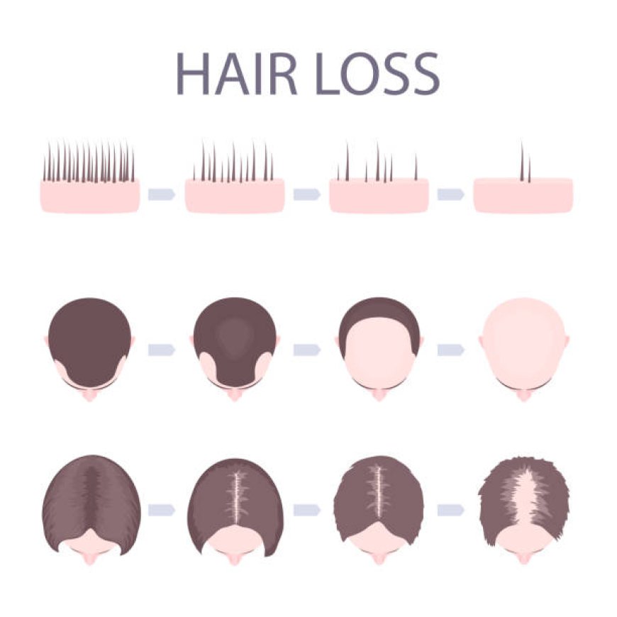 Hair Transplant for Women with Receding Hairline