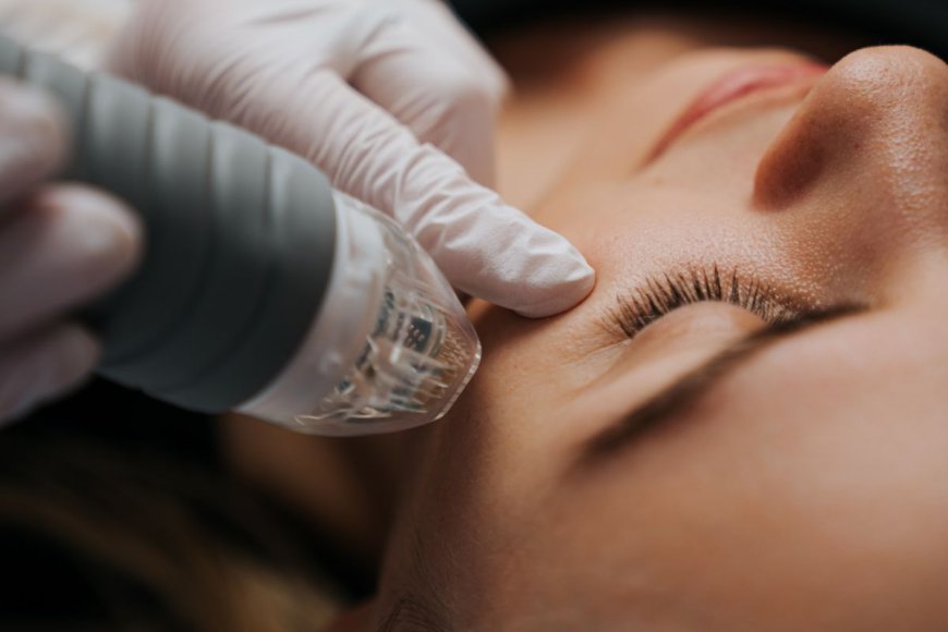 Is Fractional RF Microneedling the Best Solution for Wrinkles in Dubai?