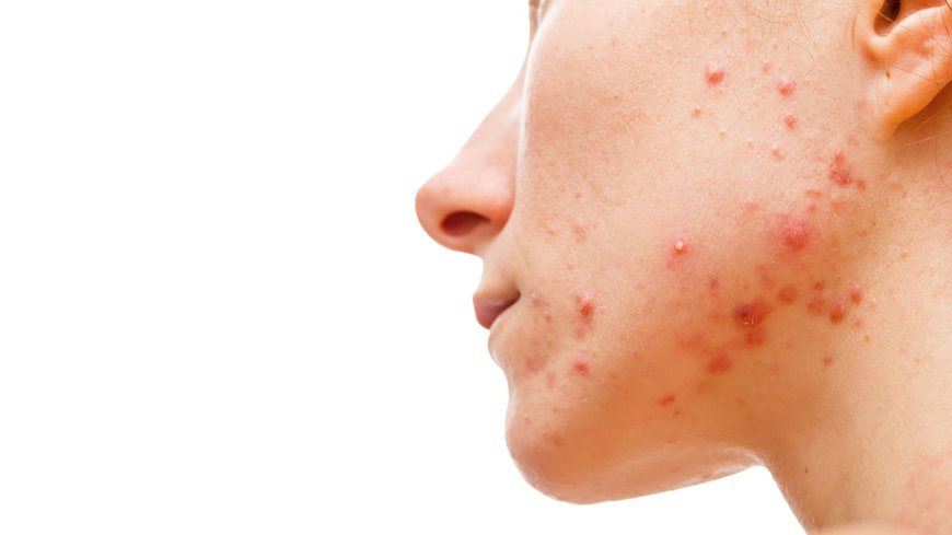 Acne Treatment for Oily Skin: What Works Best