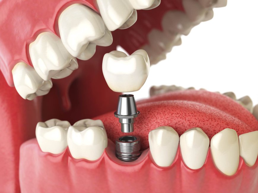 Affordable and High-Quality Dental Implants in Riyadh: What You Need to Know