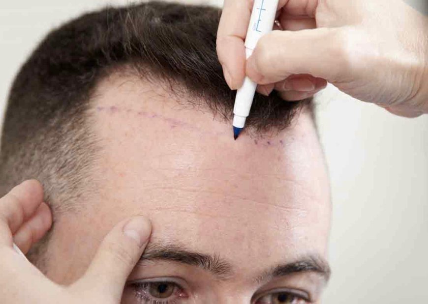 PRP Hair Treatment: A Comprehensive Guide to Hair Restoration