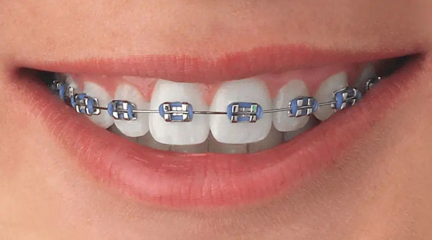 Braces Maintenance Costs: What to Expect After Getting Braces in Dubai