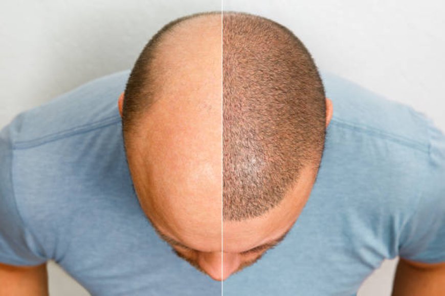 Hair Restoration Regina: Why Botox Is a Game Changer for Your Appearance