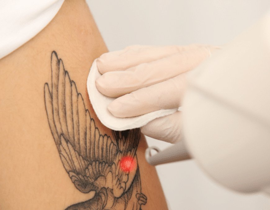 Discover How PicoSure Transforms Tattoo Removal for Faster, Smoother Results in Dubai