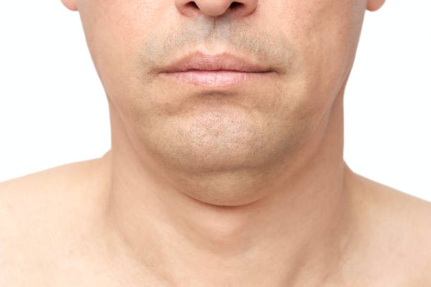 Double Chin Liposuction: Instant Results, Long-Term Benefits