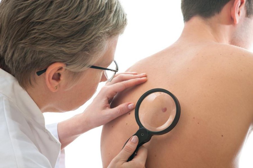 How do dermatologists in Dubai treat conditions like warts or moles?