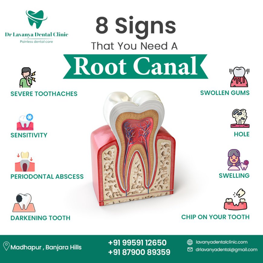 Root Canal Treatment Hospital in Hyderabad, Dental Prophylaxis Hospital, and Clinic for Loose Teeth