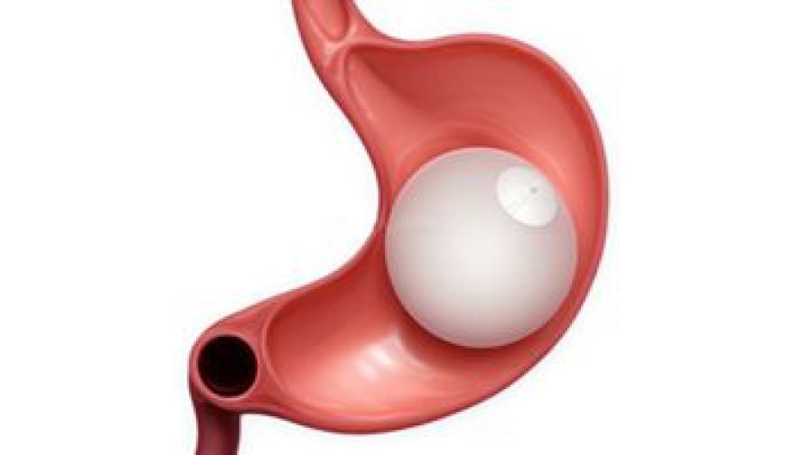 What Are the Key Differences Before and After Gastric Balloon Placement in Dubai?