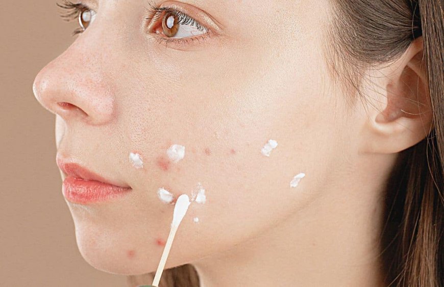 The Role of Exfoliation in Acne Treatment