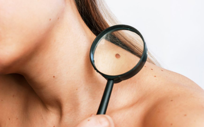 Is mole removal safe for dark-skinned individuals?