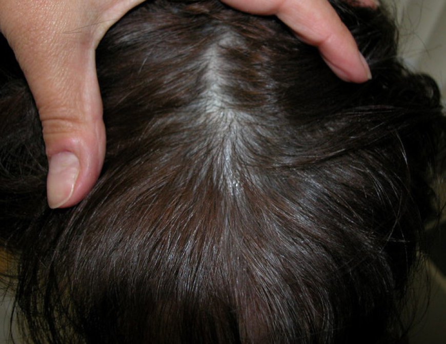 Finasteride: Key Facts for Hair Loss Sufferers