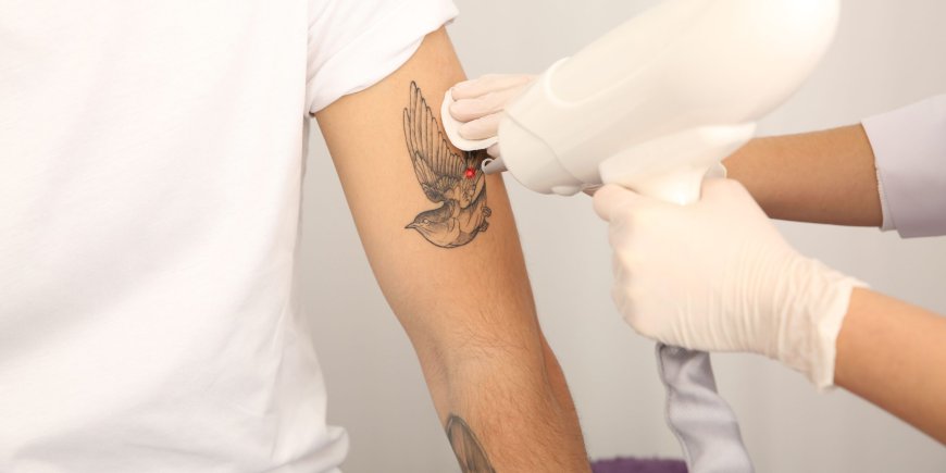 How Laser Tattoo Removal Works: Your Complete Step-by-Step Guide in Dubai