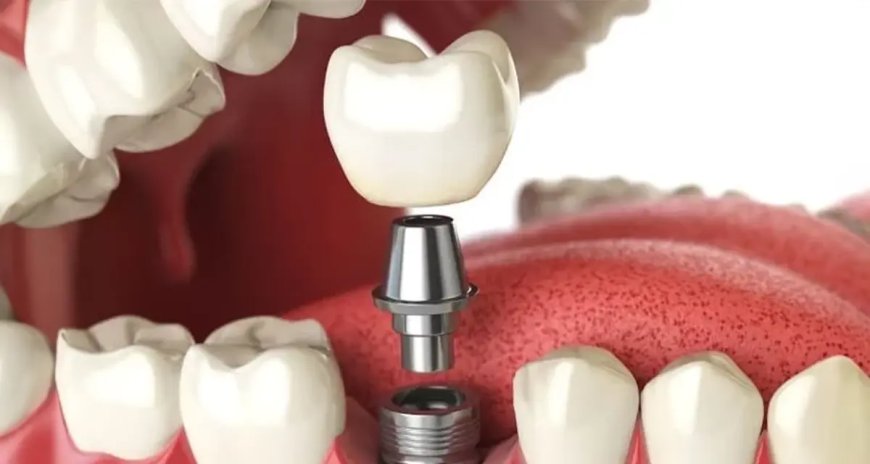 Revolutionizing Smiles: The Latest Innovative Single Tooth Implant Techniques in Dubai