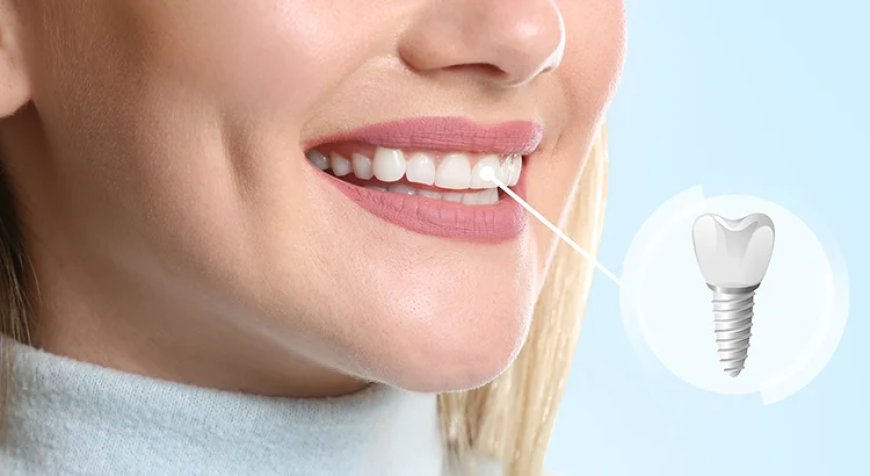 What are the Newest Dental Implant Techniques Available in Dubai?