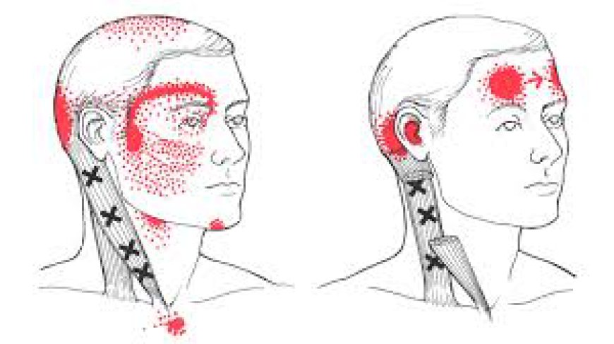 Sternocleidomastoid Pain: Causes, Symptoms & Solutions