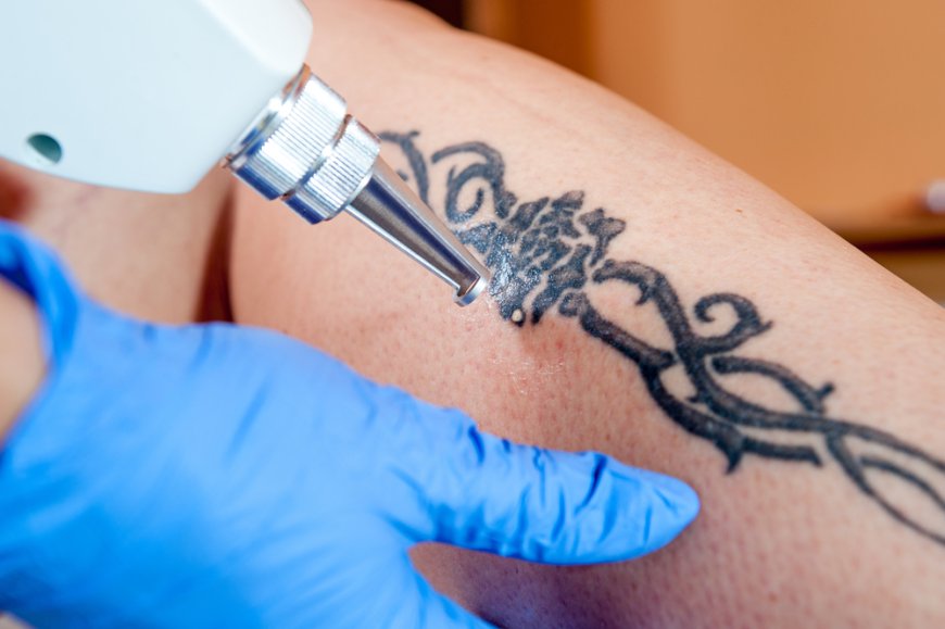 Laser Tattoo Removal in Dubai: A Non-Invasive Approach to Clear Skin