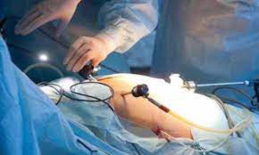 Your Ultimate Guide to Laparoscopic Gastric Sleeve in Riyadh