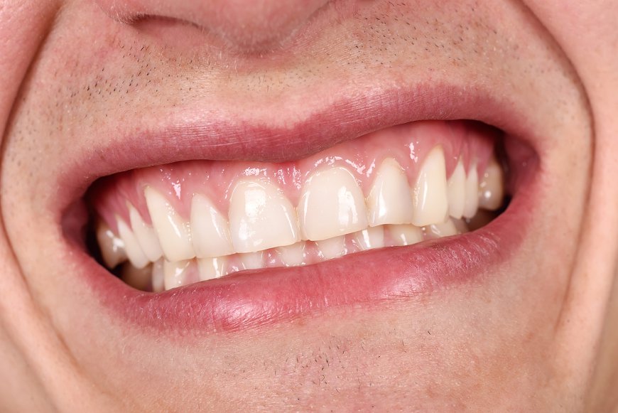 How Gum Contouring Can Correct Excessive Gum Tissue