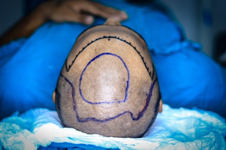 Hair transplant in Rajasthan