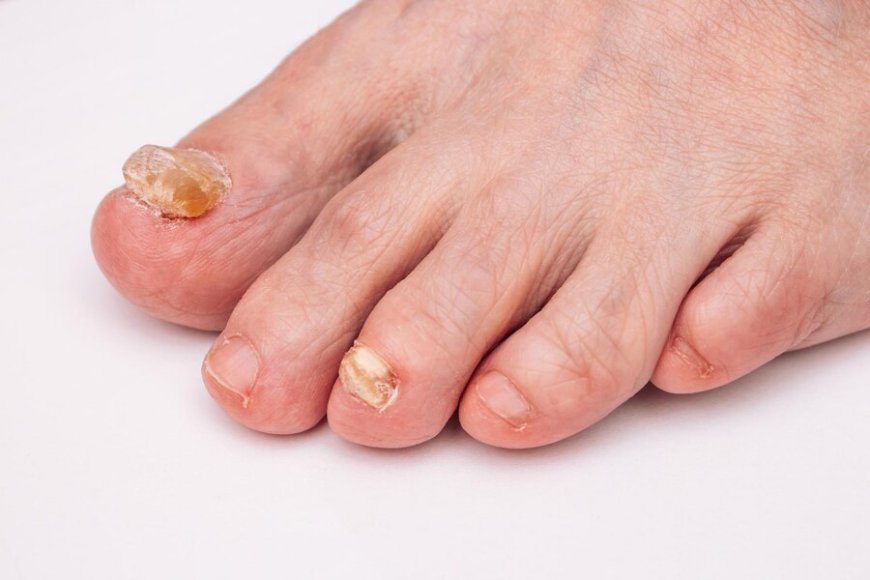 Spain Onychomycosis Market: Trends, Growth Opportunities, and Forecast Analysis