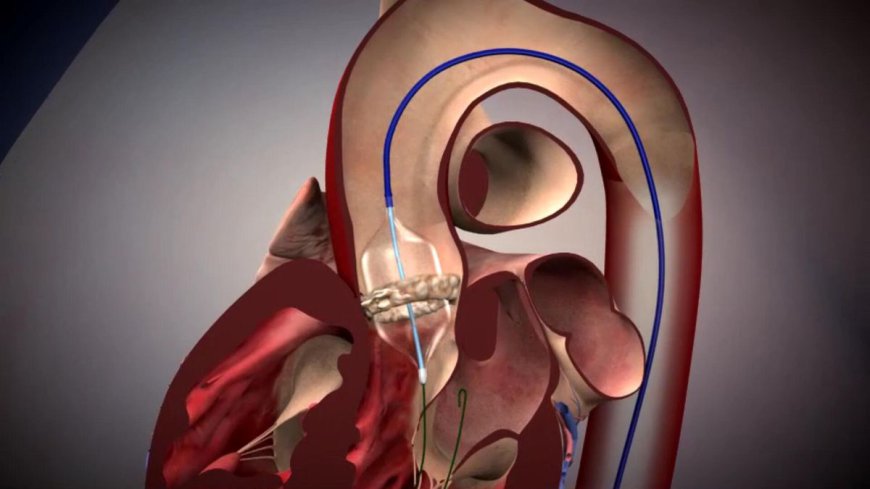 Transcatheter Aortic Valve Replacement: A Promising New Option for Patients With Severe Aortic Stenosis