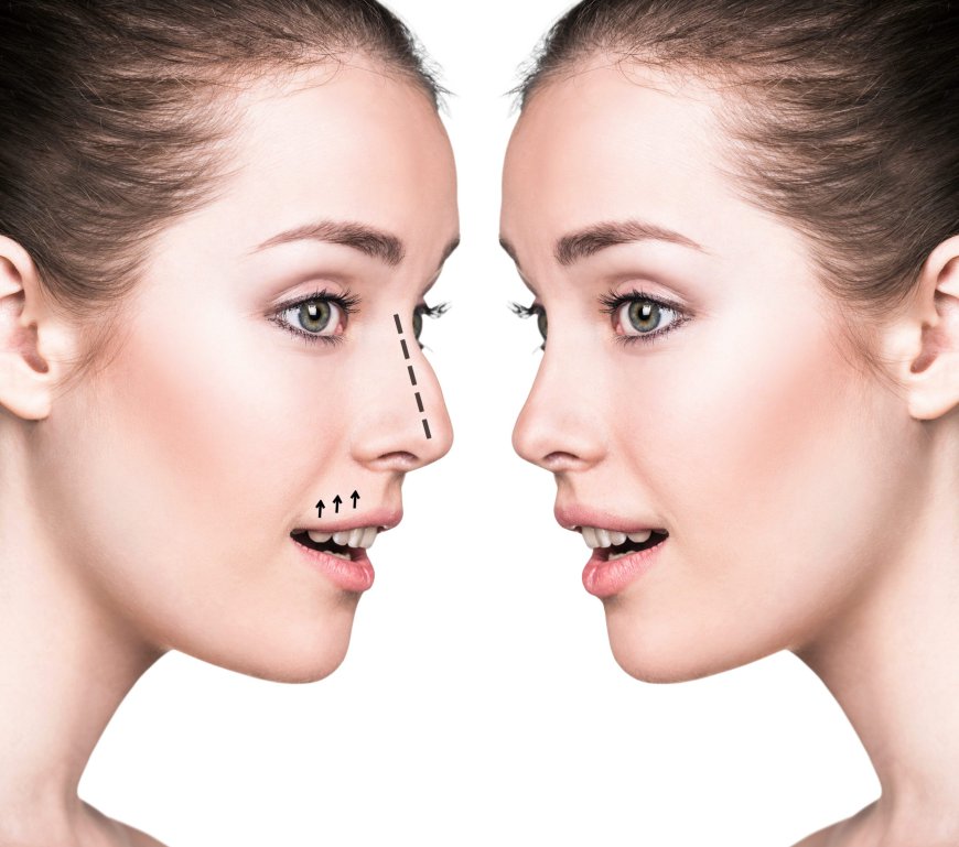 Non-Surgical Nose Jobs: The Safe, Effective Way to Reshape Your Nose in Dubai