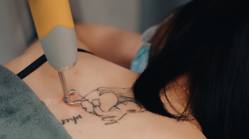 Smooth, Tattoo-Free Skin Awaits with Laser Removal in Dubai