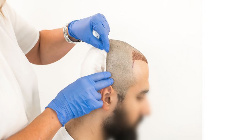 Does hair transplant affect sperm?