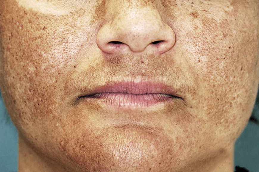 The Latest Developments in Melasma Treatment in Dubai  Everything You Need to Know