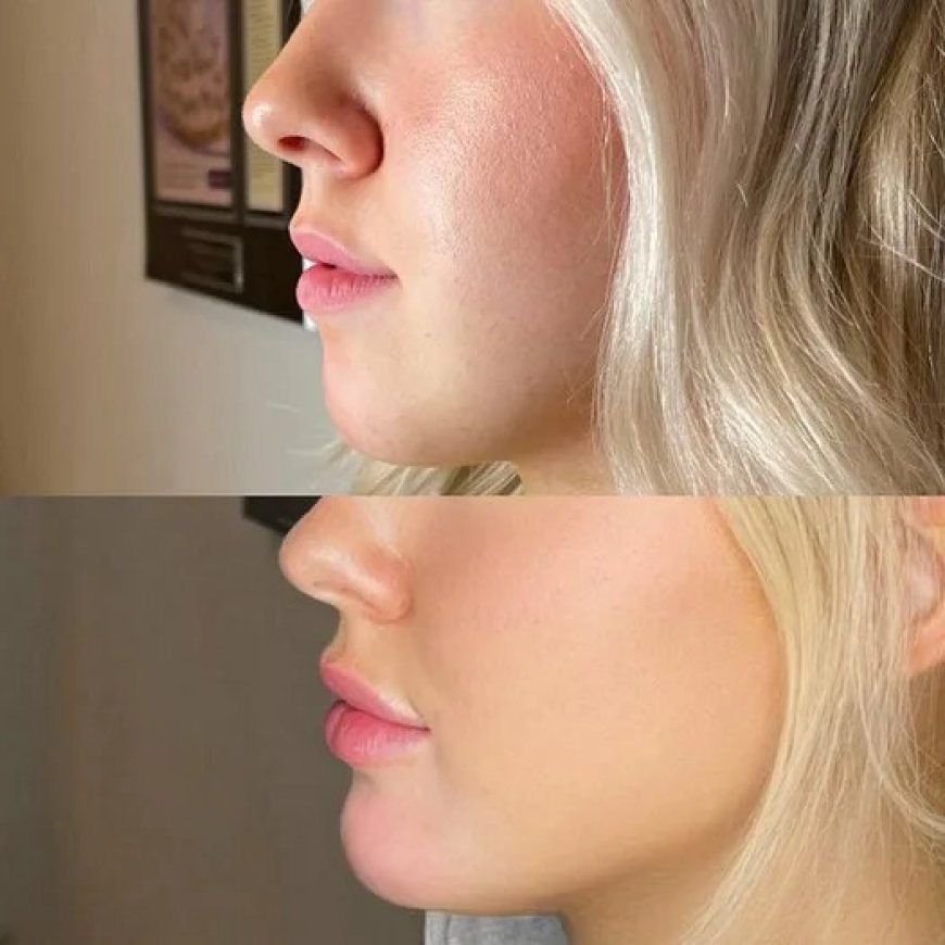 What Makes Chin Fillers in Dubai a Safe and Effective Solution for Chin Contouring