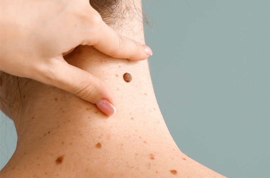 Are skin tag removal patches effective?