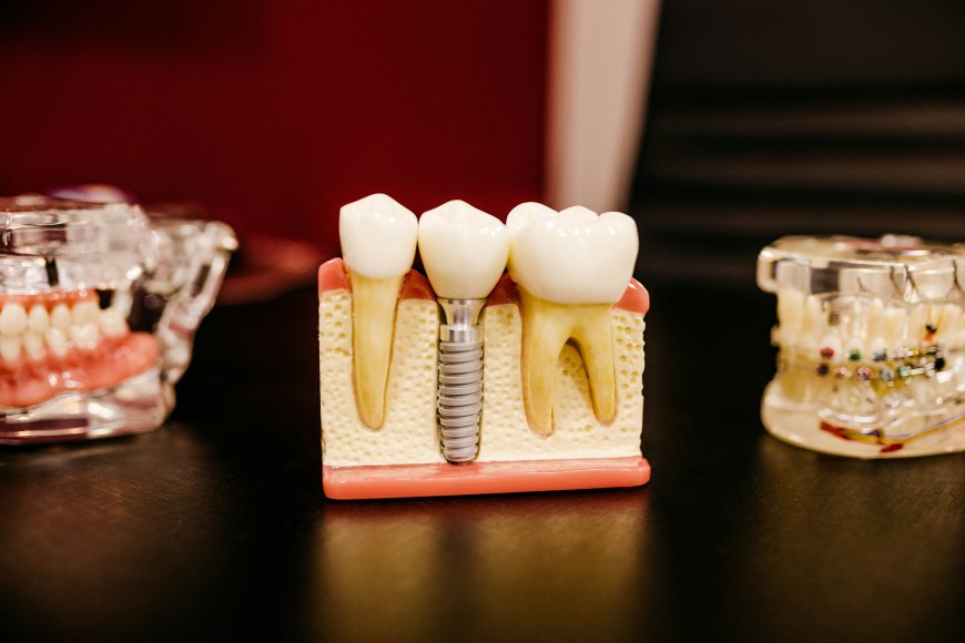 The Benefits of Choosing Dental Implants Over Dentures