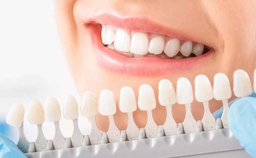 Rising Awareness of Dental Aesthetics to Propel Growth of the Global Dental Veneers Market