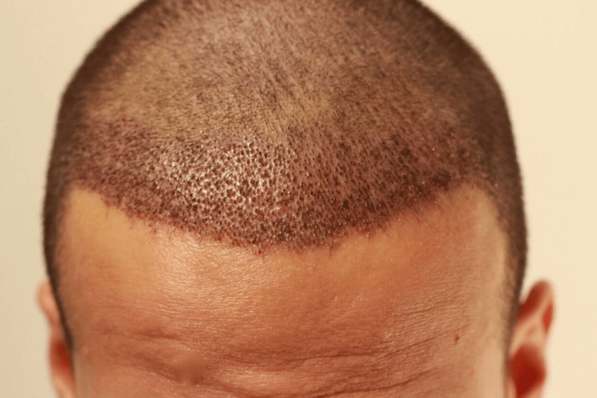 Hair Transplant For Women In Dubai