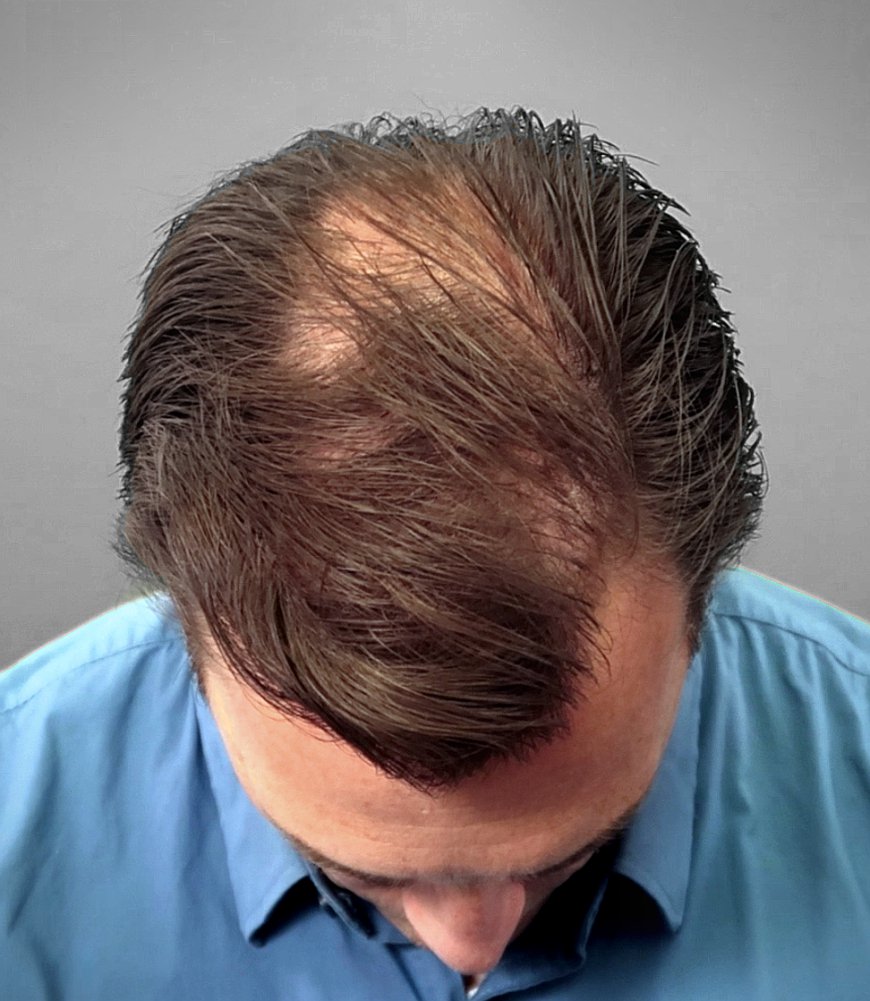 How Long Should You Continue Using Finasteride for Hair Loss?