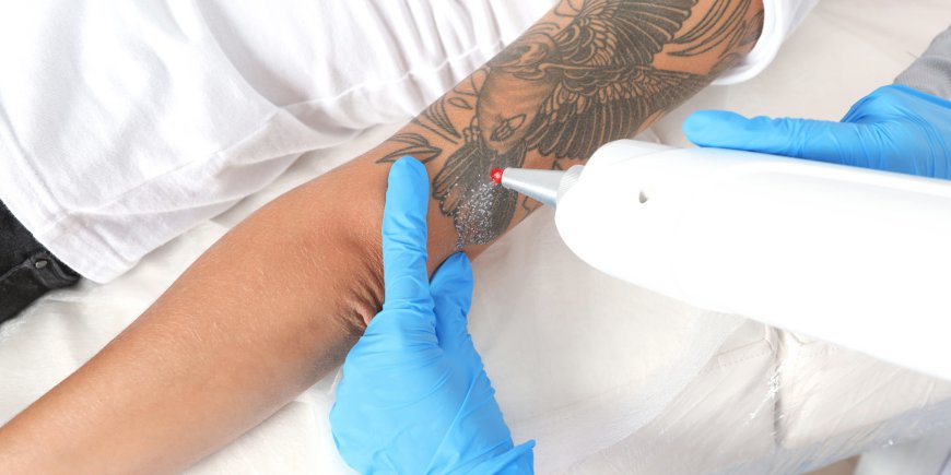 Redefining Your Canvas: Laser Tattoo Removal in Dubai