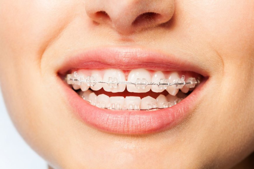 How Much Do Teeth Braces Cost in Dubai?