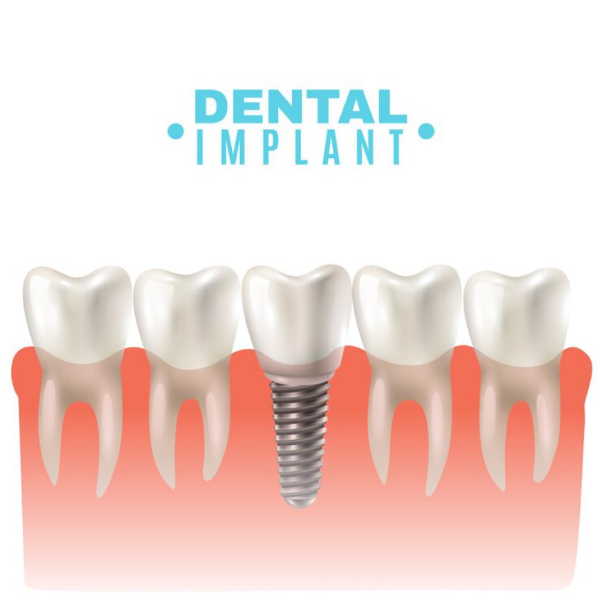 Dental Crowns vs. Dental Implants: Which is Best?