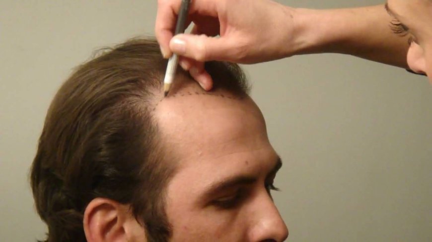 Benefits Of Hair Transplant In Dubai