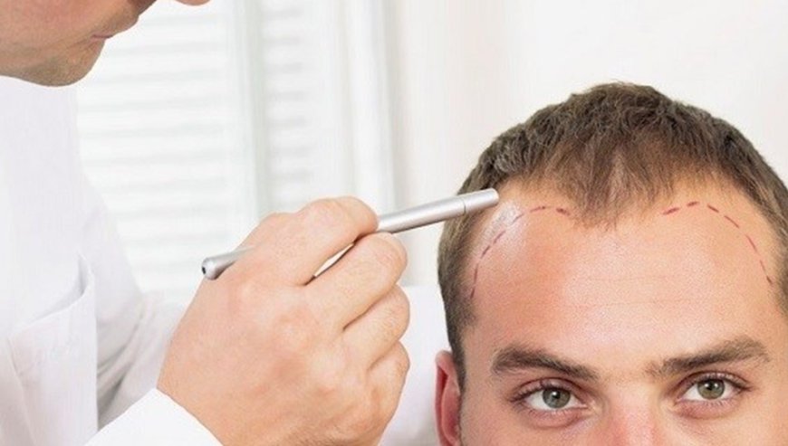 What Is The Recovery Time For Prp Hair Treatment?