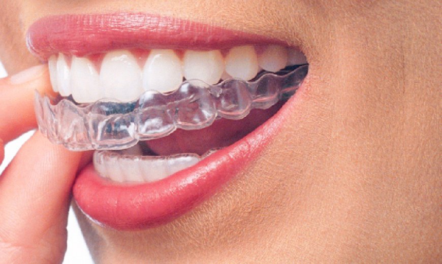 Is Invisalign Braces the Best Option for Adults?